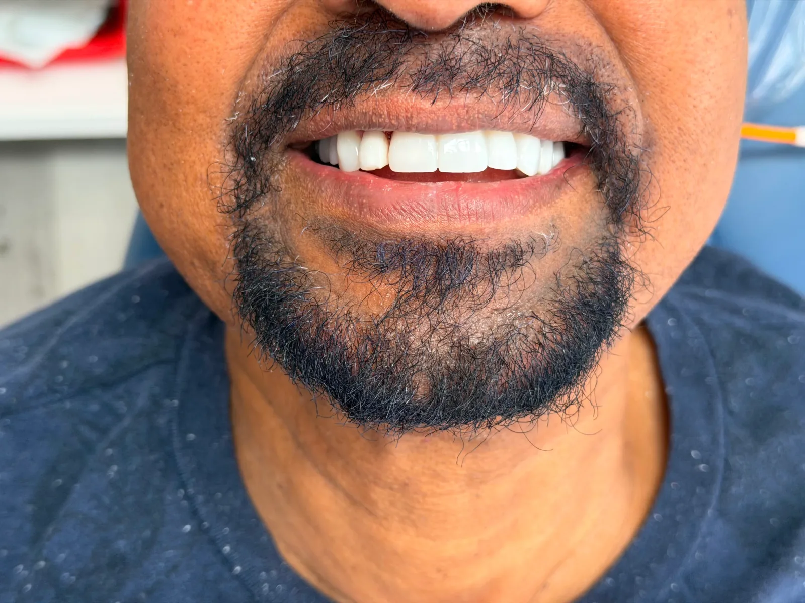 Patient smile after teeth whitening in Woodbridge, VA