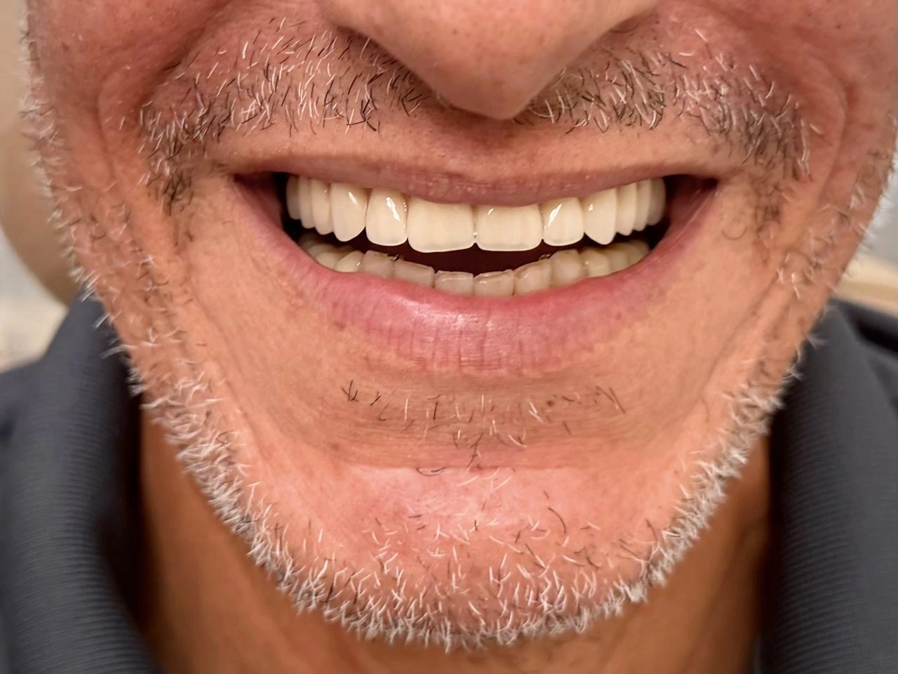 Close-up of a patient smile after restorative dental care